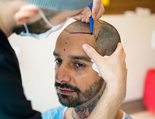 Can you do 5000 grafts in one session?