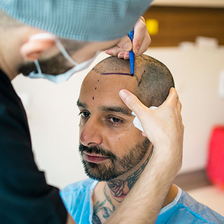 Sapphire FUE Hair Transplant