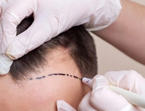 How much does 1000 grafts hair transplant cost?